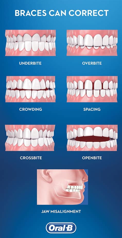 When To Get Braces Oral B