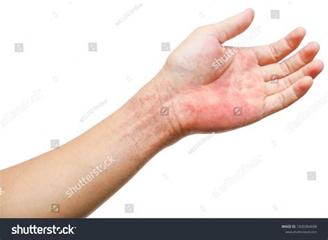 Red Rash On Wrist Hand Isolated Stock Photo 1500384698 Shutterstock