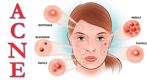 Discover The Types Of Acne You Have Inside Humans