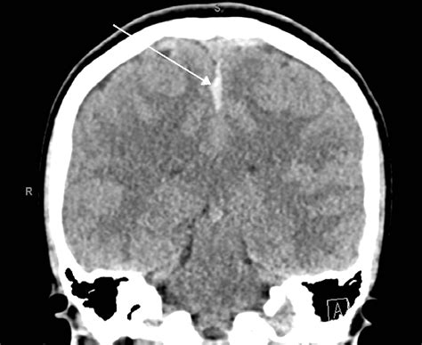 Cureus Post Dural Puncture Subdural Hematoma A Rare Iatrogenic Complication Of Neuraxial