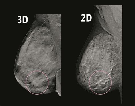 Southwest Health The Benefits Of 3d Mammograms And The Importance Of