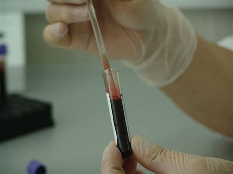 Blood Test To Detect Early Stage Cancer Dr Hempel Digital Health Network