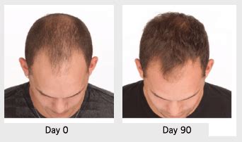 The role testosterone and dht have on hair loss. Hair Loss Treatments | Swetnam Cosmetic | Fayetteville, AR