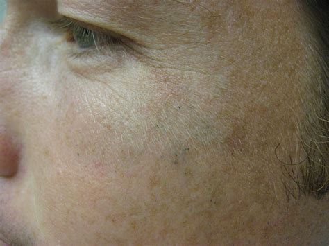 Bilateral Facial Pigmentation