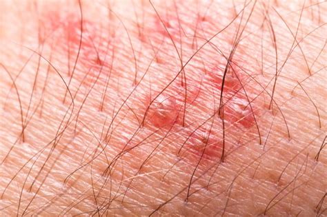 What Are The Early Symptoms Of Shingles 6 Steps