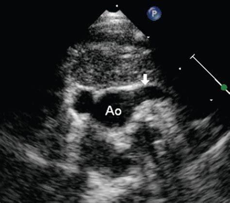 Right Aortic Arch Ultrasound