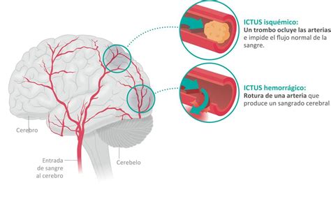 Cerebral venous sinus thrombosis (cvst), cerebral venous and sinus thrombosis or cerebral venous thrombosis (cvt), is the presence of a blood clot in the dural venous sinuses (which drain blood from the brain), the cerebral veins, or both. ICTUS - Daño Cerebral Adquirido - Señales de alerta