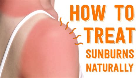 how to prevent and treat sunburns youtube