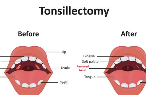 Tonsillectomy Surgery In India Cost Hospitals And Doctor