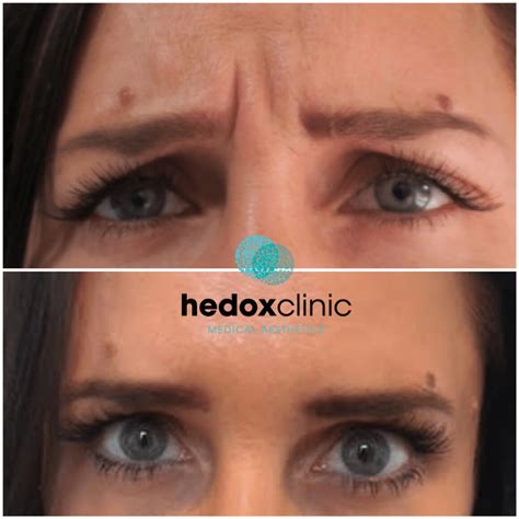 Frown Line Filler London Forehead Wrinkles Treatment Hedox Clinic