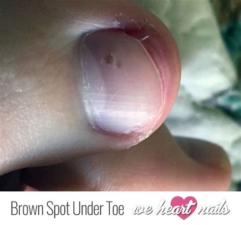 Two weeks later a spot under my big toe has popped up with no pain. What is the Brown Spot Under My Toenail? | Toe nails ...