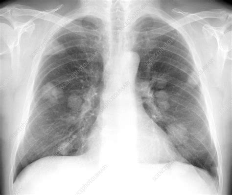 In this group, it is expected that more than 50% live a year after the surgical removal of the mass. Secondary lung cancers, X-ray - Stock Image C015/4615 ...