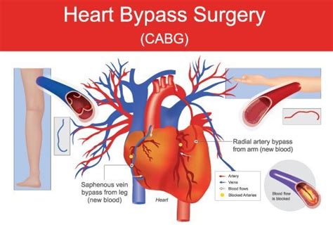 Coronary Artery Bypass Grafting Cabg At Affordable Cost In Hyderabad