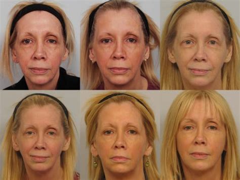 Voluma And Sculptrapersky Sunder Facial Plastic Surgery Thoughts In