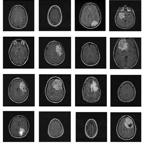 Brain Tumor Identification And Classification Of Mri Images Using Deep