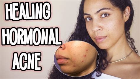 How I Treat Hormonal Acne Breakouts In 4 Steps Hormonal Acne Acne
