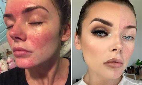 Beautician Battling Severe Rosacea Reveals The Products That Banished