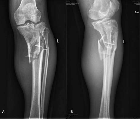 Preoperative X Rays Of The Tibial Plateau A Frontal And B Lateral