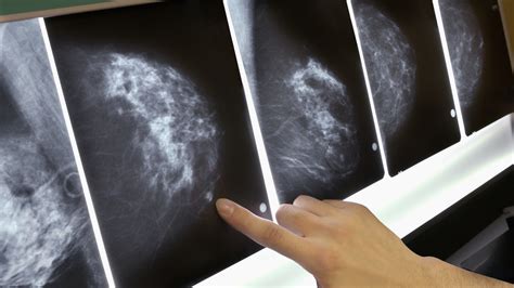 breast cancer genomic test can rule out need for chemo shots health news npr