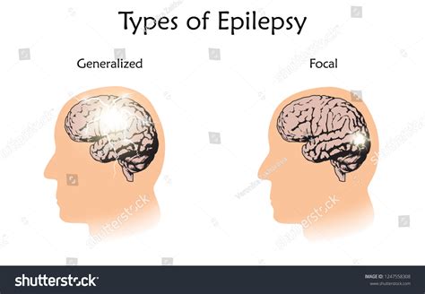 Types Epilepsy Vector Medical Illustration Generalized Image