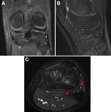 Magnetic Resonance Imaging Of The Left Knee In A Coronal B