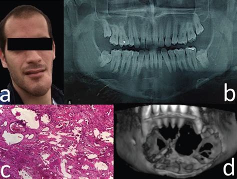 Aneurysmal Bone Cyst Of The Mandible With Conservative Surgical