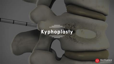 Kyphoplasty Causes Symptoms And Recovery