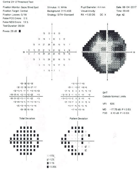 Humphreys Visual Field Test Of The Right Eye Sita Standard 24 2