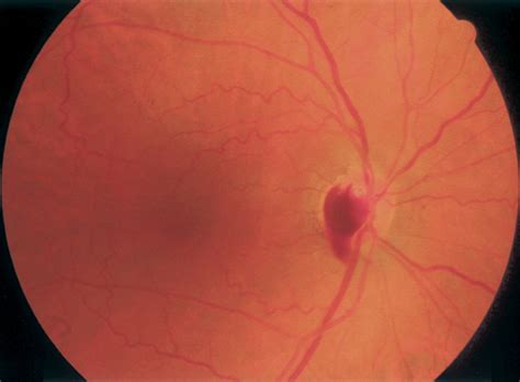 Photograph Showing Optic Disc Haemorrhage Covering Temporal Half Of The