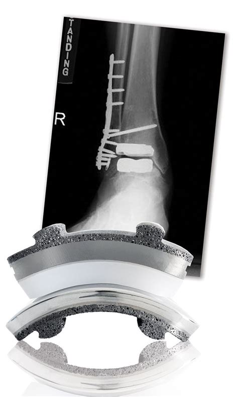 Pin On Total Ankle Replacement
