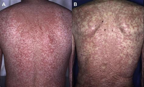 Clinical Similarity Between Ampicillin Rash In Infectious Mononucleosis
