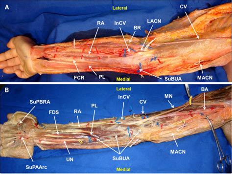 The arteries smaller branches are called arterioles and capillaries. Right upper limb showing the anomalous course of the superficial... | Download Scientific Diagram