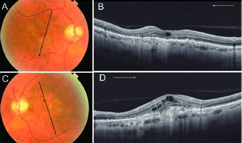 Descubre lo que gaby hernandez (gabyho72) encontró en pinterest, la colección de ideas más grande del mundo. Degeneracion De La Macula Y Del Polo Posterior Del Ojo ...