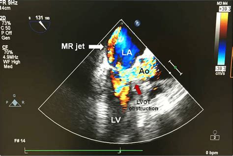 Intraoperative Transesophageal Echocardiography With Color Flow Doppler