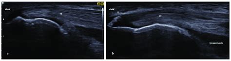 Ultrasound Images Of The Distal Triceps Tendon Tt A Normal