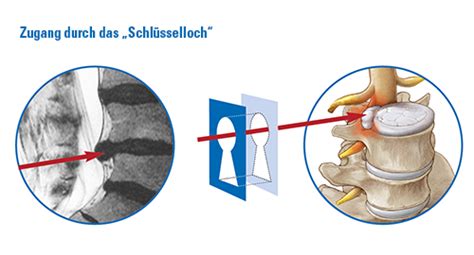 Endoskopische Bandscheiben Operation Orthmed Fachärzte Für Orthopädie