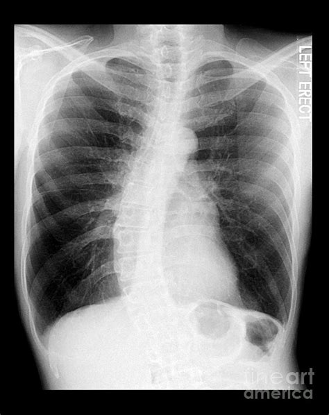 Chest X Ray Copd And Scoliosis Photograph By Medical Body Scans
