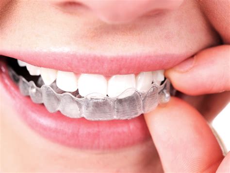 Hawley retainer these are the retainers which are removable and need to be worn usually at night before sleeping. Vivera Retainers: All You Need To Know | Orthodontics in ...