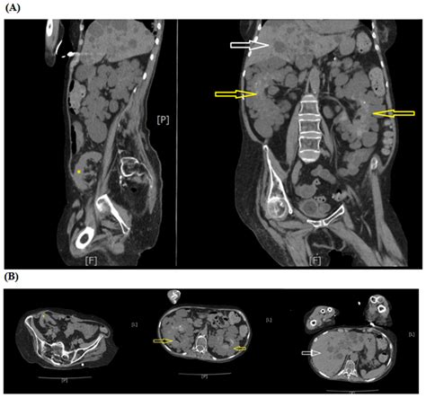 Figure 2 Ct Scan Abdomen And Pelvis Without Intravenous Contrast A