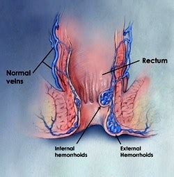 They often feel itchy and painful. Hemorrhoid Banding - Atlanta Gastroenterology Associates