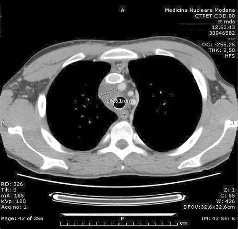 The Chest Ct Scan Performed At The End Of The Dosedense Chemotherapy