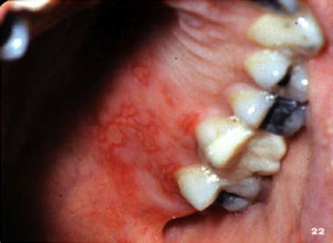 Stomatitis Herpetic Gingivostomatitis Herpetic Herpes Simplex Oral