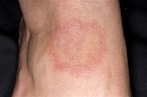 Ringworm Photograph By Dr P Marazziscience Photo Library
