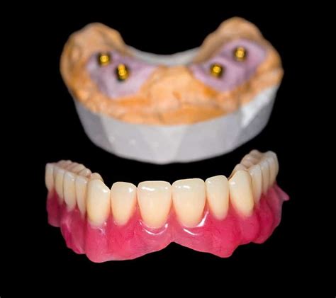 Differences Between Implant Retained And Supported Dentures