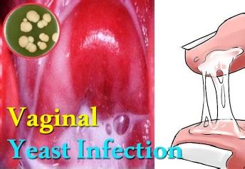 Understanding Vaginal Yeast Infections Natural Yeast Infection Treatment