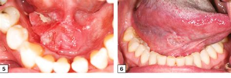 Racgp Common Benign And Malignant Oral Mucosal Disease