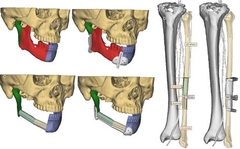 Mandibular Reconstruction With The Vascularized Fibula Flap Comparison