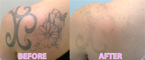 Share 97 About Skin After Tattoo Removal Super Hot Indaotaonec
