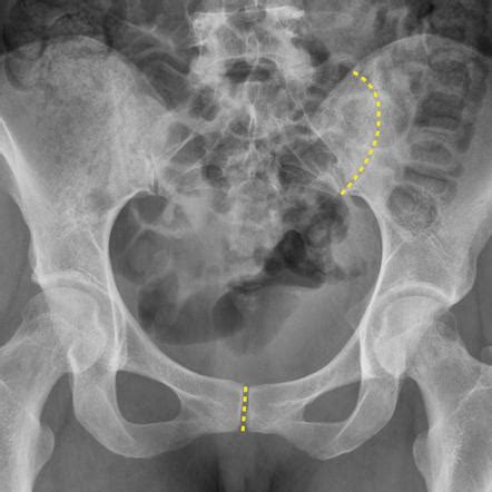 It begins at the sciatic notch and courses inferiorly to the medial border of the ischium. Pelvis annotated x-ray | Image | Radiopaedia.org