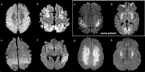 90 Amazing Can You See Anoxic Brain Injury On Mri Insectza